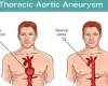 Understanding about aortic aneurysm thoracic abdominal