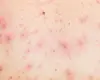Chickenpox symptoms and how it spreads in children