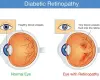 Diabetic retinopathy - A leading cause of blindness