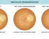 Macular degeneration - Understanding AMD and its types