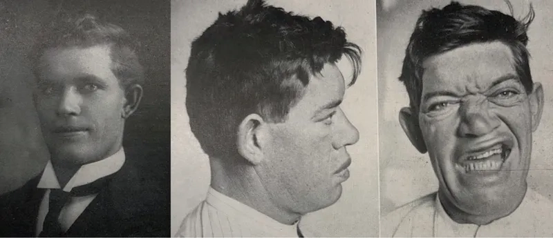 Noticing large hands and feet in acromegaly cases