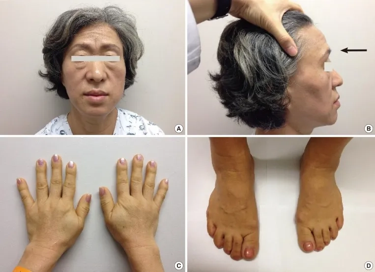 Recognizing acromegaly symptoms for early diagnosis