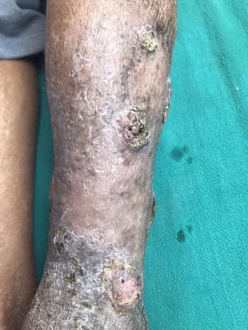 Understanding if Acinetobacter baumannii is contagious