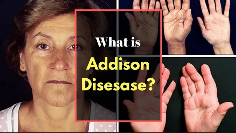 Early Addison's disease symptoms awareness
