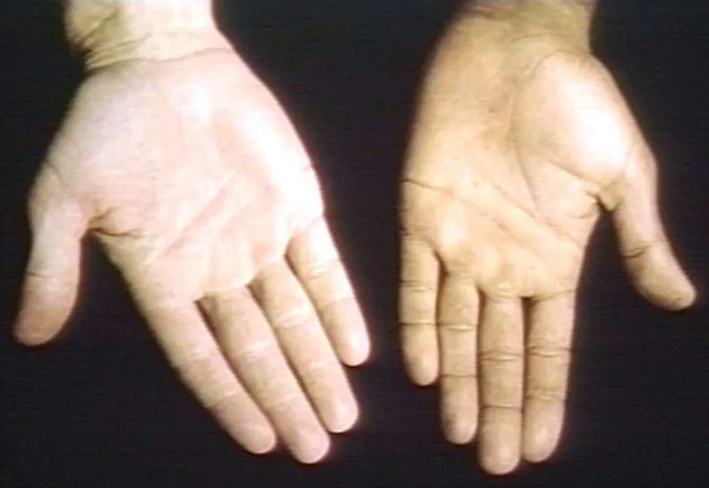 Adrenal insufficiency medical illustration