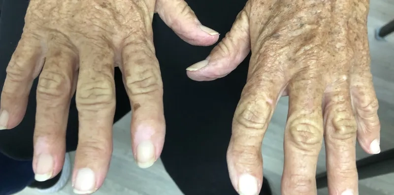 Addison's disease diagnosis process chart