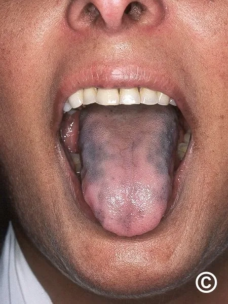 Medical emergency of adrenal crisis depicted