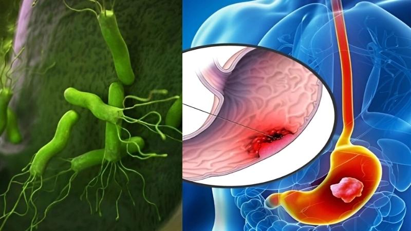 Adenovirus Gastroenteritis abdominal pain signs