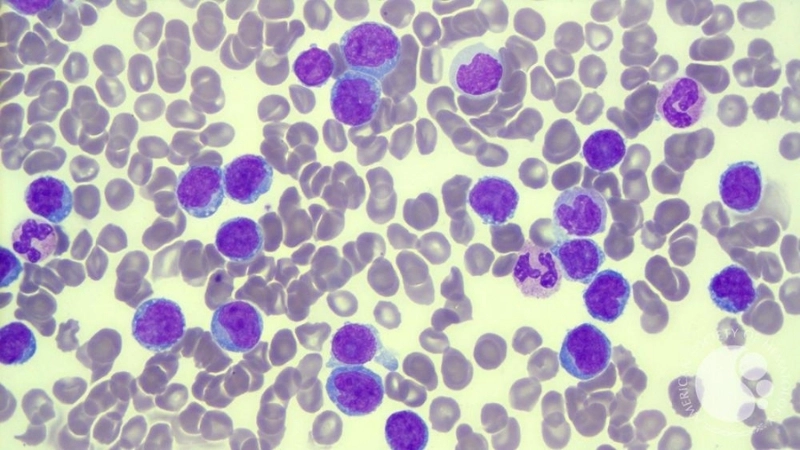 Adult T-cell Leukemia/Lymphoma seen in adult T-cell leukemia