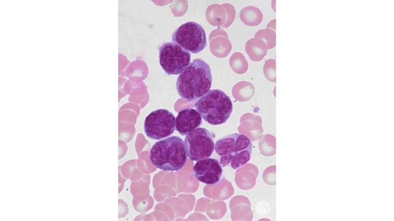 Adult T-cell Leukemia/Lymphoma confirmed with ATL diagnosis