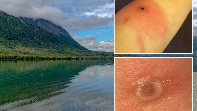 Alaskapox prevention includes wildlife caution