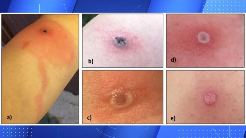 Alaskapox deer link sparks research interest