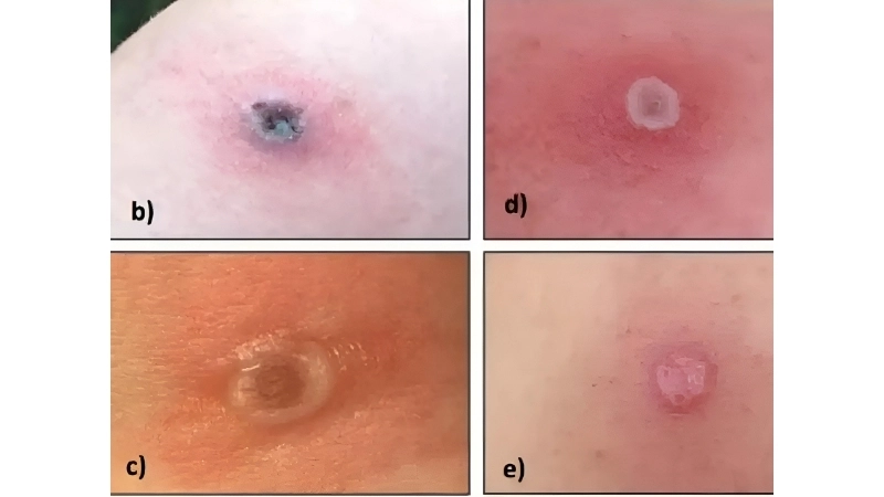 Alaskapox cases increase raise public concern