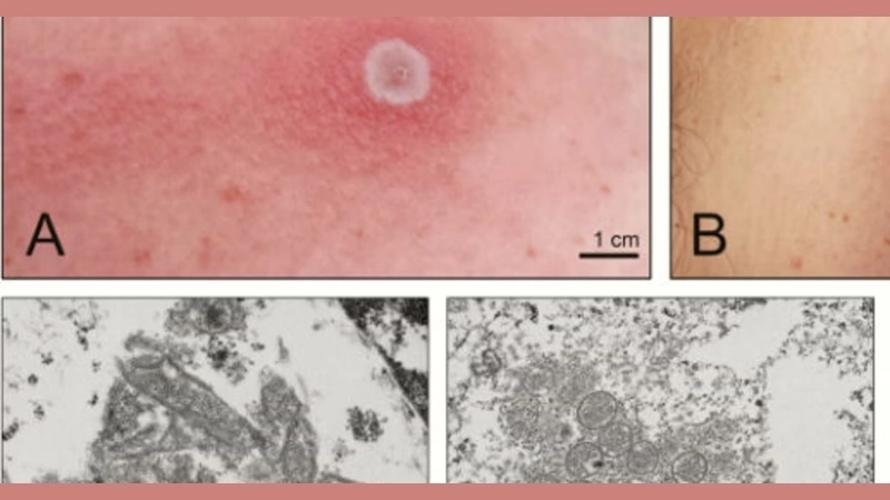 Alaskapox CDC issues updates on the virus