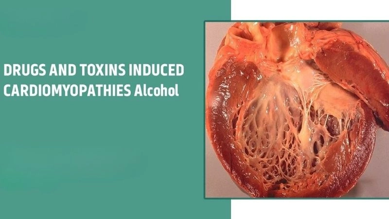 Alcoholic cardiomyopathy symptoms warning signs of heart damage