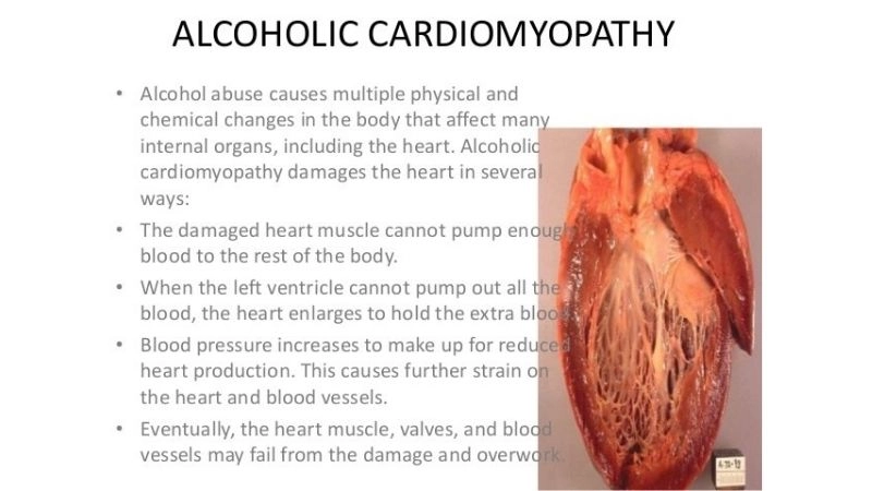 Alcoholic cardiomyopathy treatment steps to support heart health
