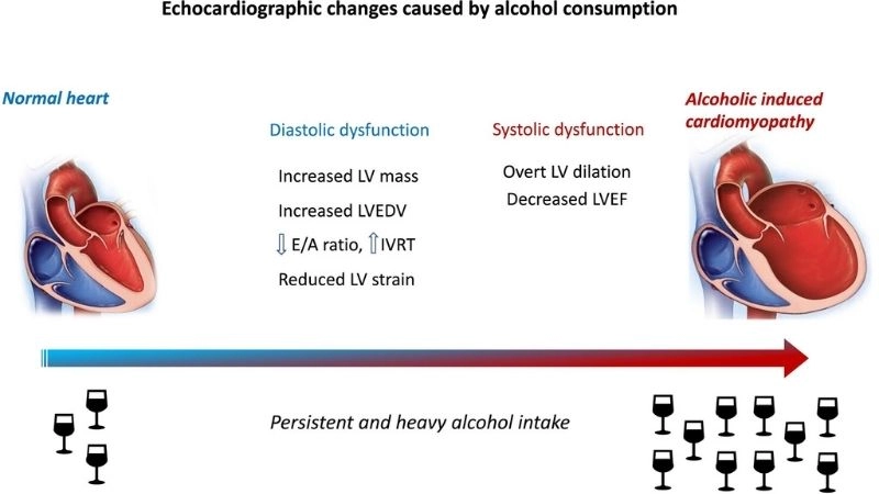 Alcoholic cardiomyopathy diagnosis early detection saves lives