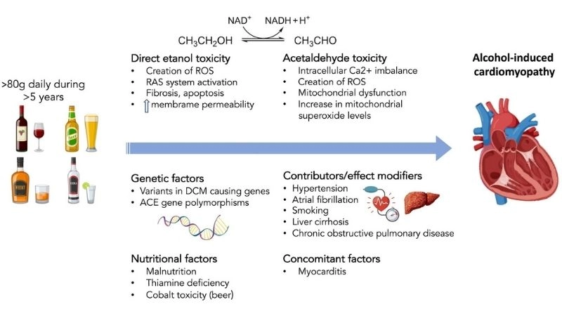 Alcohol induced cardiomyopathy damage from long term drinking