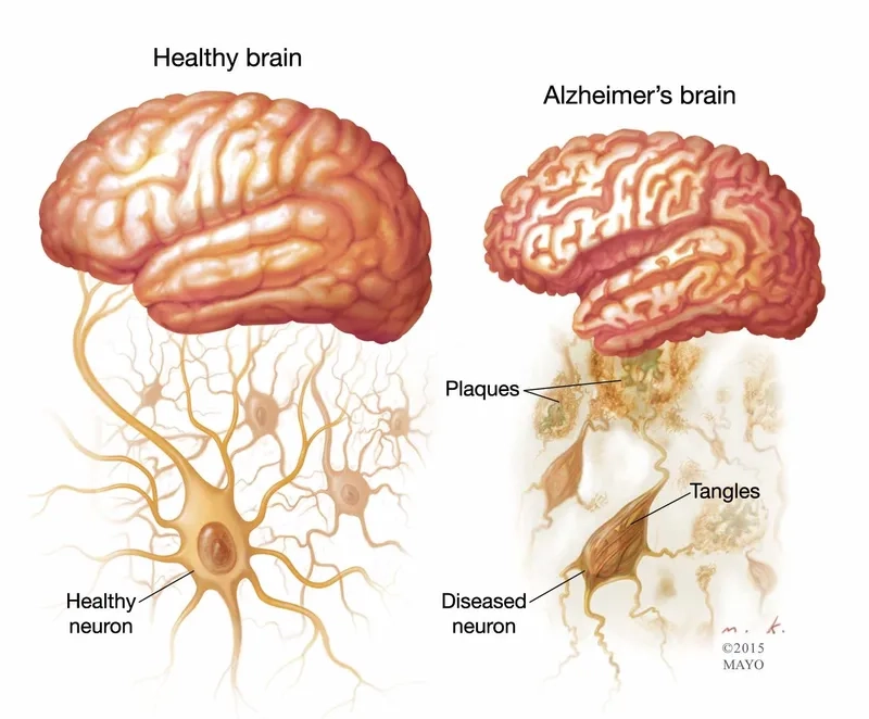 The key Alzheimer's symptoms to watch for