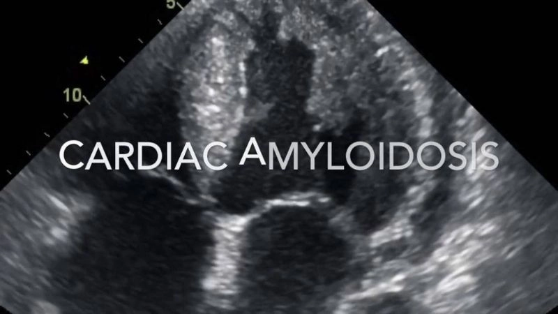 Amyloidosis treatment managing organ and heart health