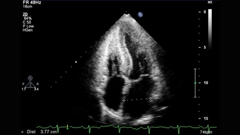 Causes of cardiac amyloidosis understanding underlying triggers