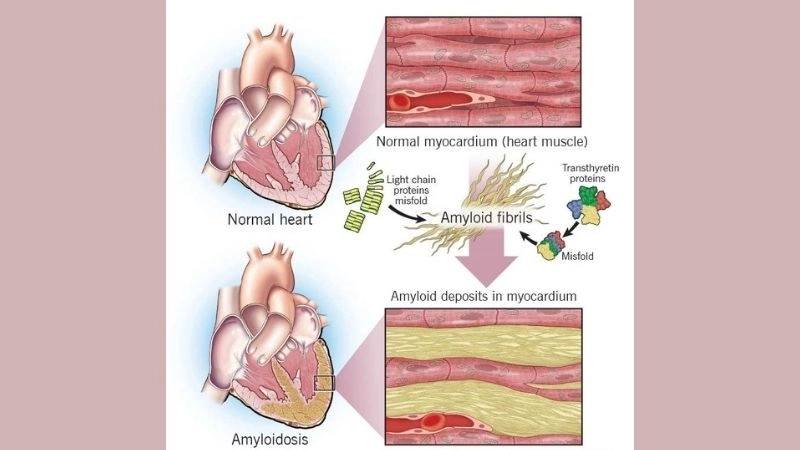 Amyloidosis diagnosis early detection improves outcomes