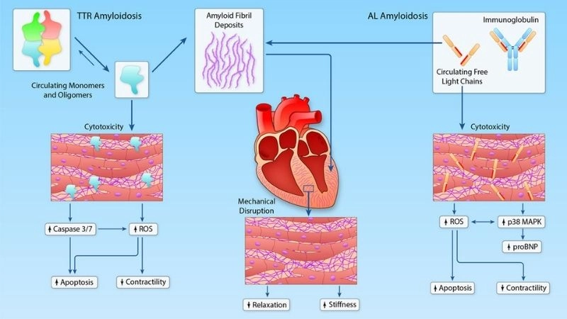 Amyloidosis heart failure risk of serious cardiac complications