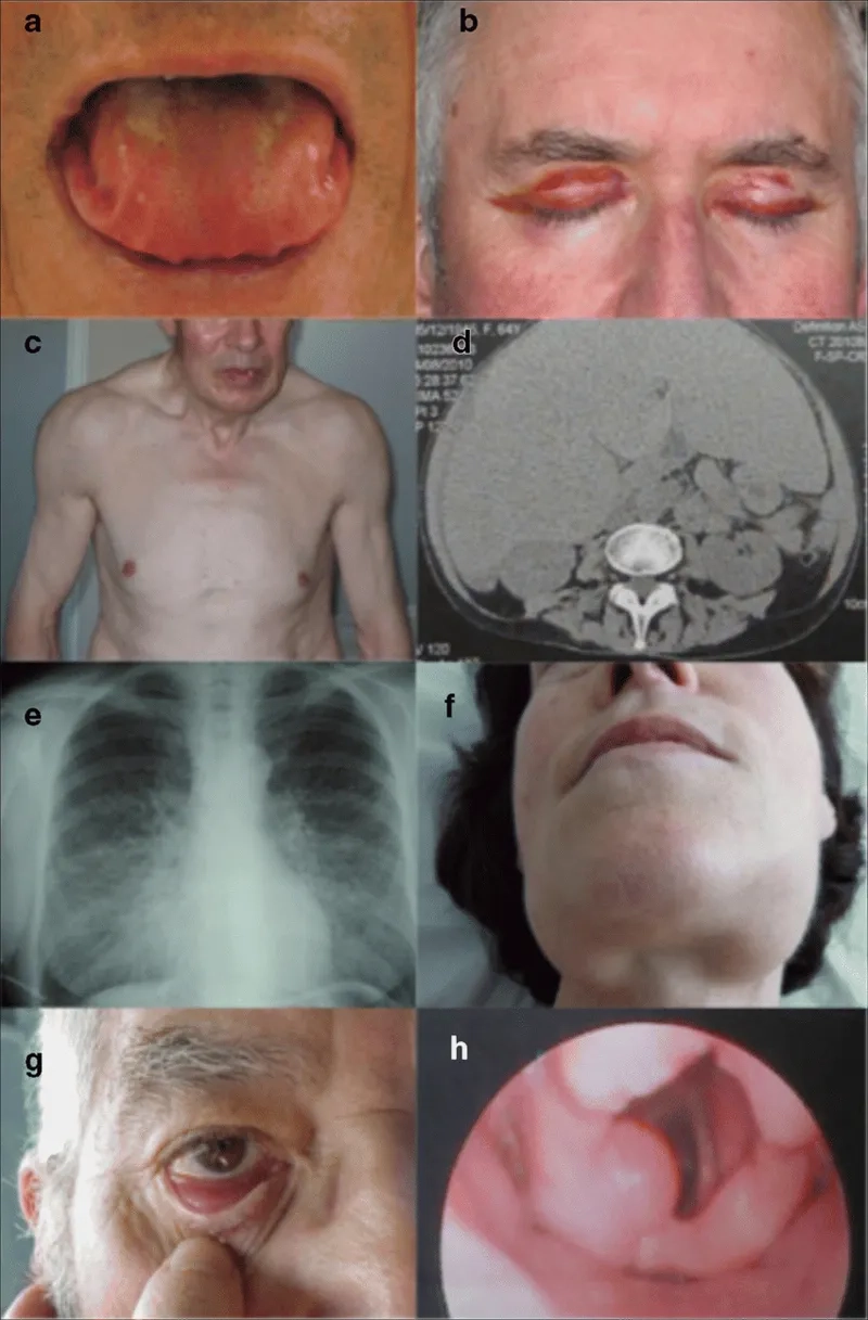 Chart displaying amyloidosis life expectancy