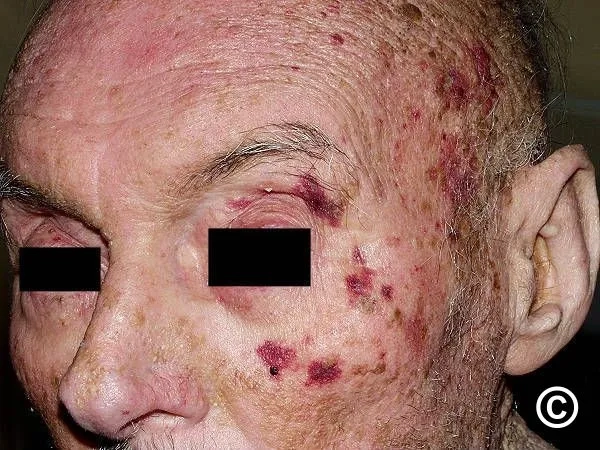 Clinical image highlighting AL amyloidosis