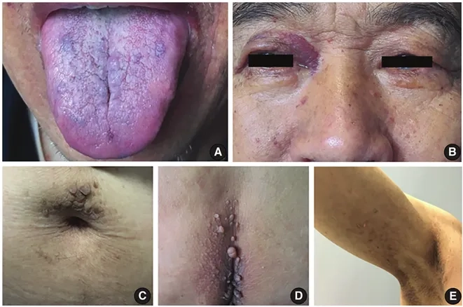 Medical photo illustrating amyloidosis symptoms