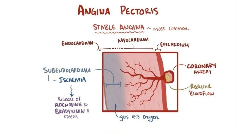 Hidden truths inside angina pectoris disease