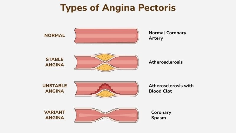 Rare type called variant angina pectoris