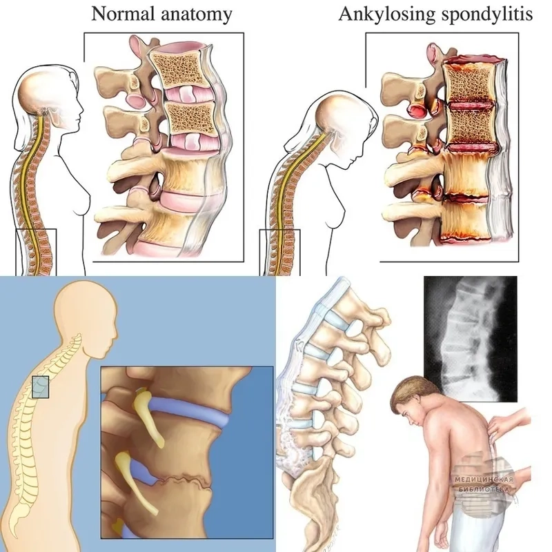 Managing daily life with ankylosing spondylitis