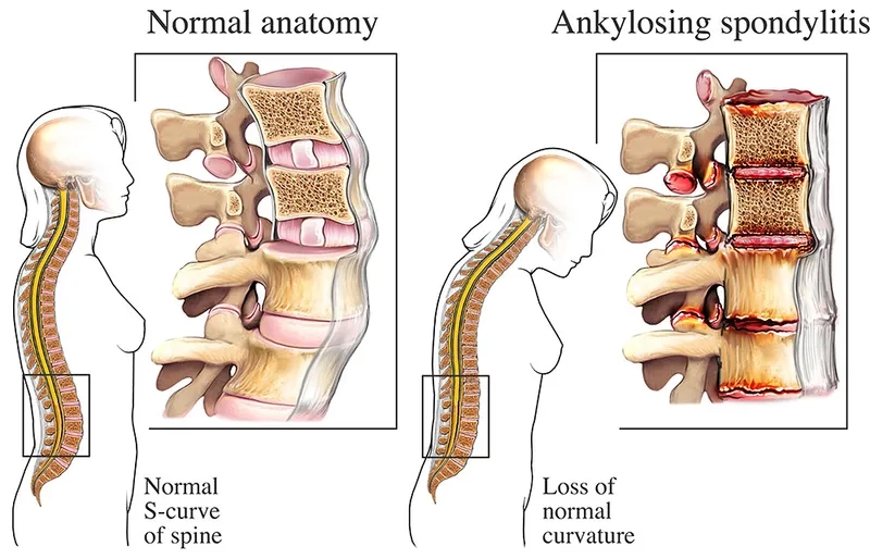 The progression of spinal fusion in AS