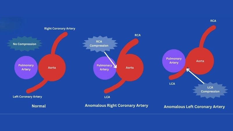 Anomalous left coronary artery diagnosis accurate detection methods