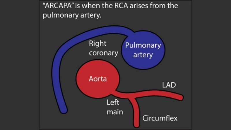 Anomalous left coronary artery treatment medical and surgical care