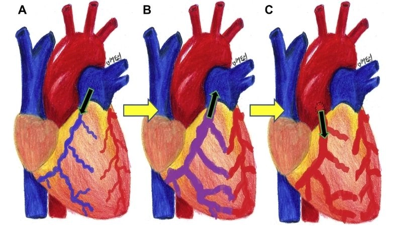 ALCAPA adult presentation rare late onset of coronary defect