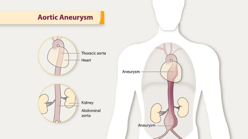 Common aortic aneurysm symptoms requiring attention