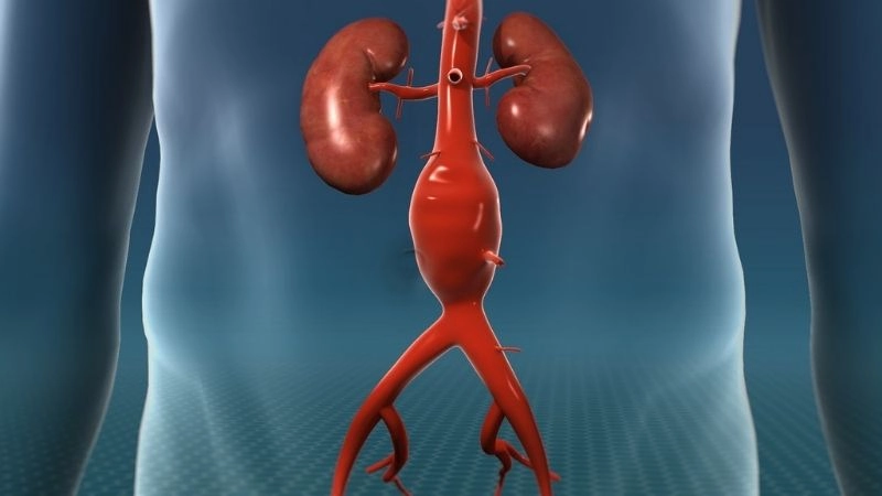 Aortic aneurysm surgery as a life saving option