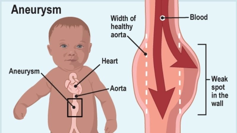 Effective aortic aneurysm treatment methods today