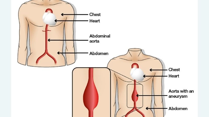 Main aortic aneurysm causes and risk elements
