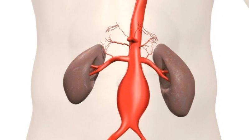 Aortic aneurysm rupture as a deadly emergency