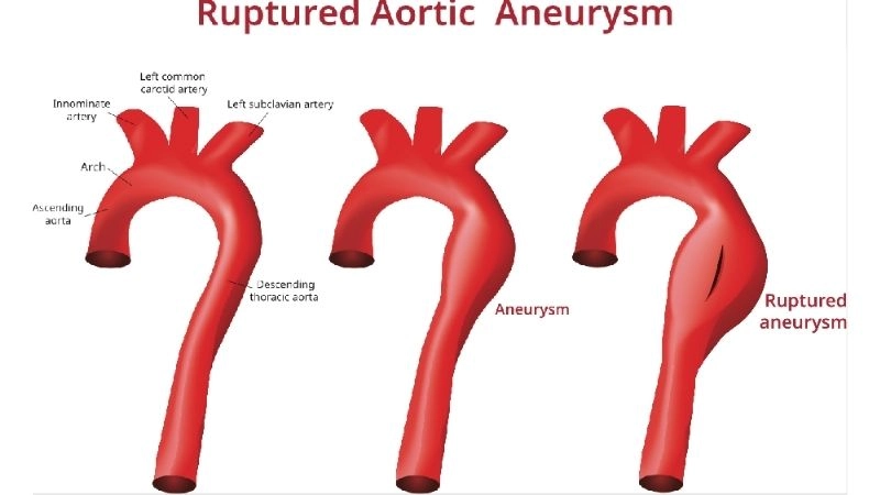 Aortic aneurysm repair to restore vessel integrity