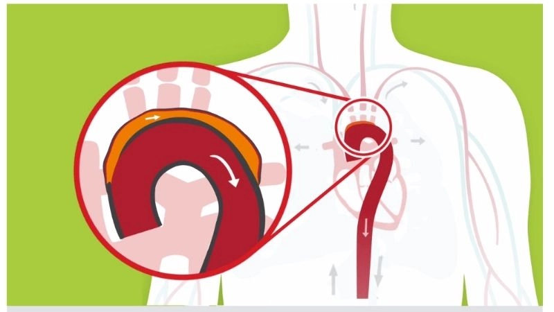 Thoracic aortic aneurysm diagnosis with imaging