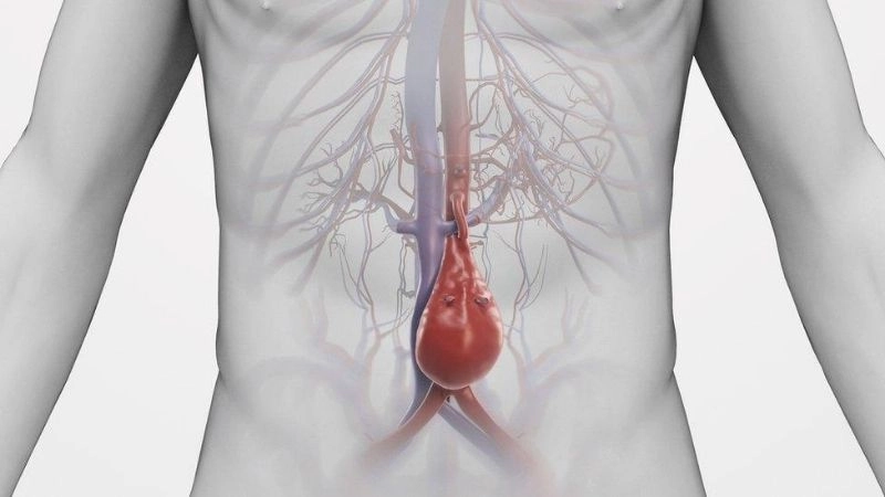 Aortic dissection and life threatening complications