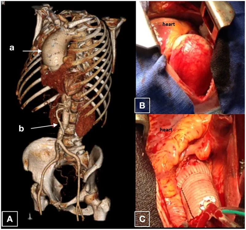 Location of a thoracic aortic aneurysm in the chest