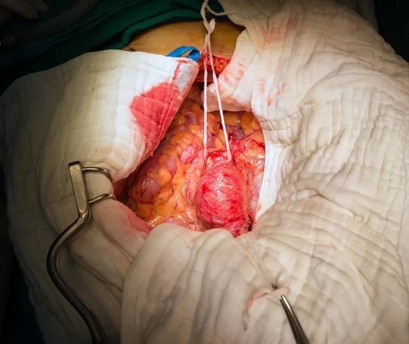 Infographic of the main causes of aortic aneurysm