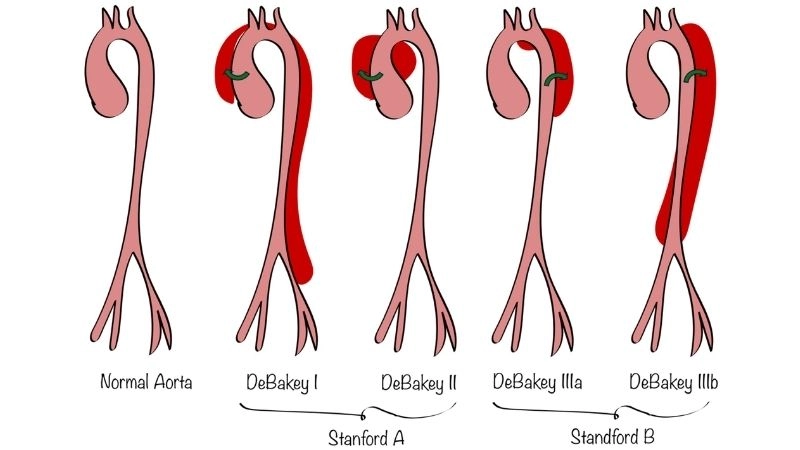 Effective aortic dissection treatment approaches today