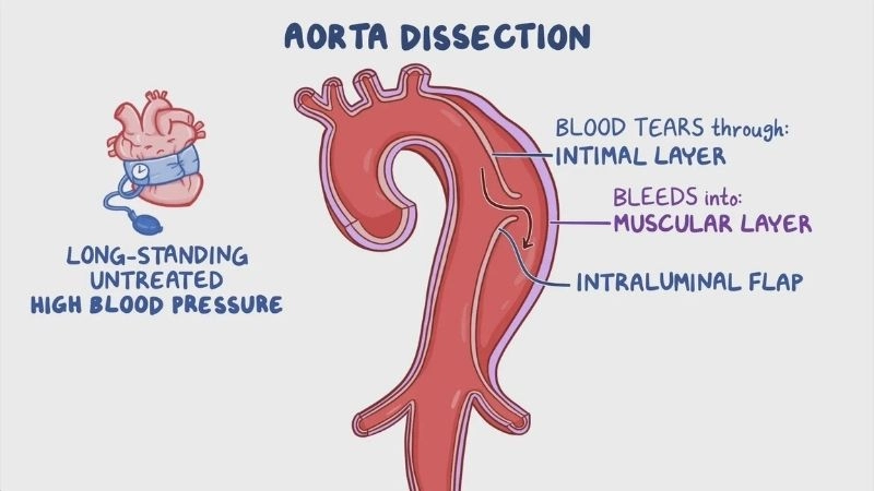 Major aortic dissection causes and risk elements