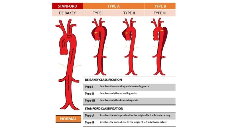 Accurate aortic dissection diagnosis through imaging